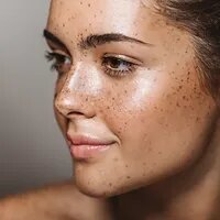 Tratamientos de medicina estética en Mallorca | Anti Manchas